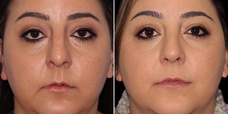 Open Rhinoplasty Results In Atlanta GA